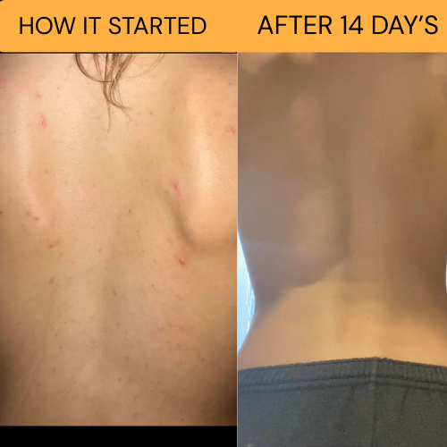 Holi -All natural bacne clear