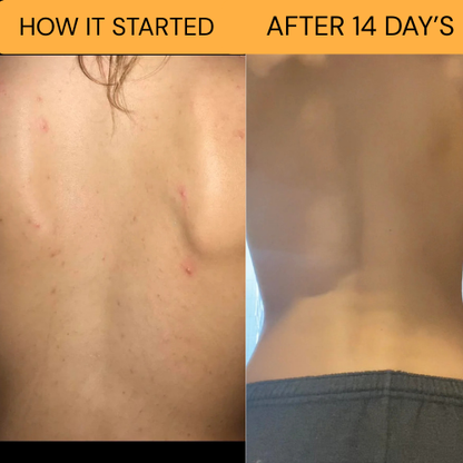 Holi -All natural bacne clear