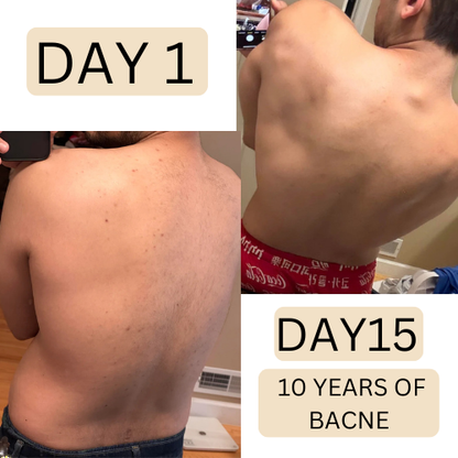 Holi -All natural bacne clear